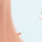 Stielwarzen-Entferner