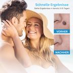 Stielwarzen-Entferner