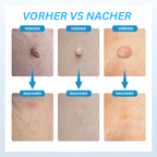 Stielwarzen-Entferner