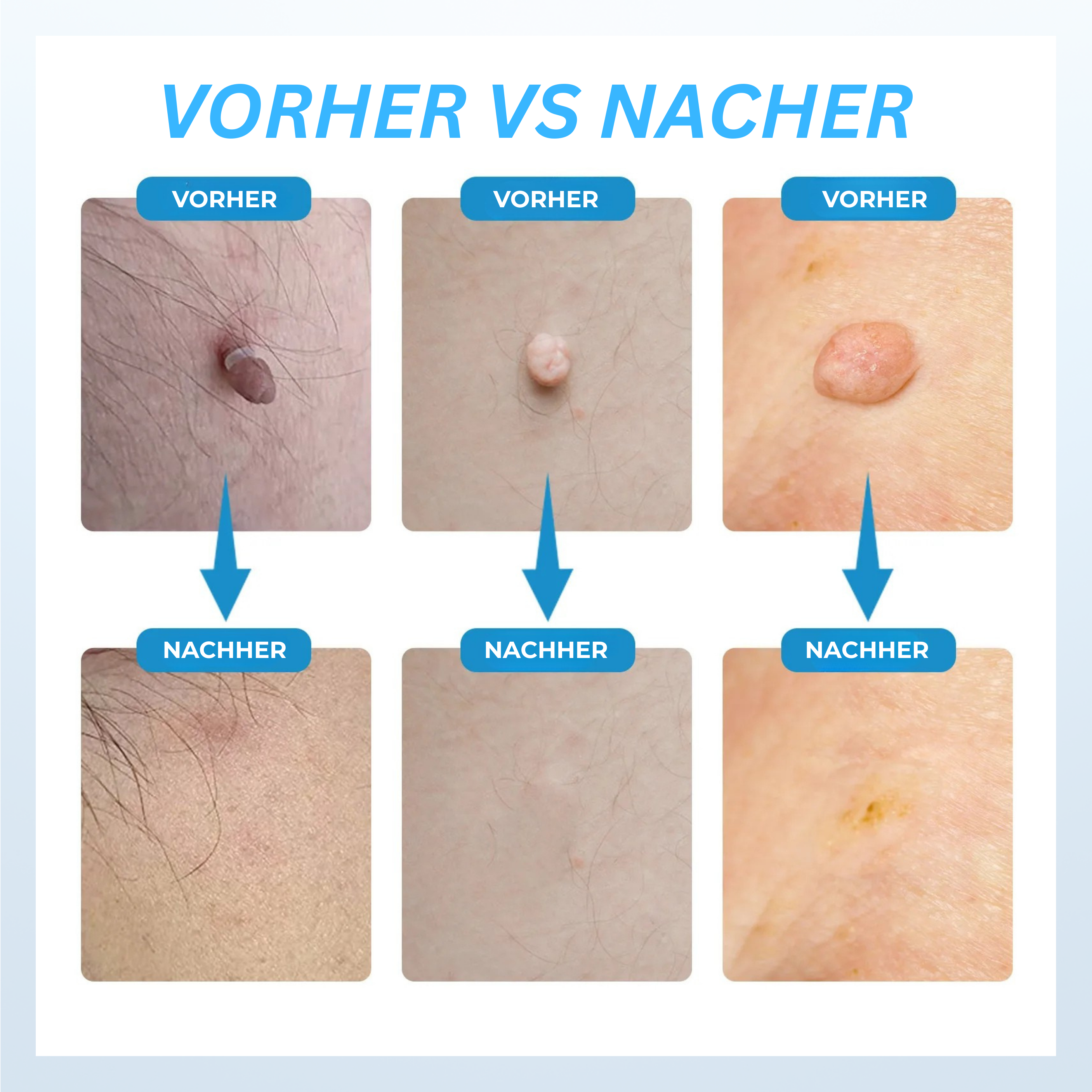 Stielwarzen-Entferner