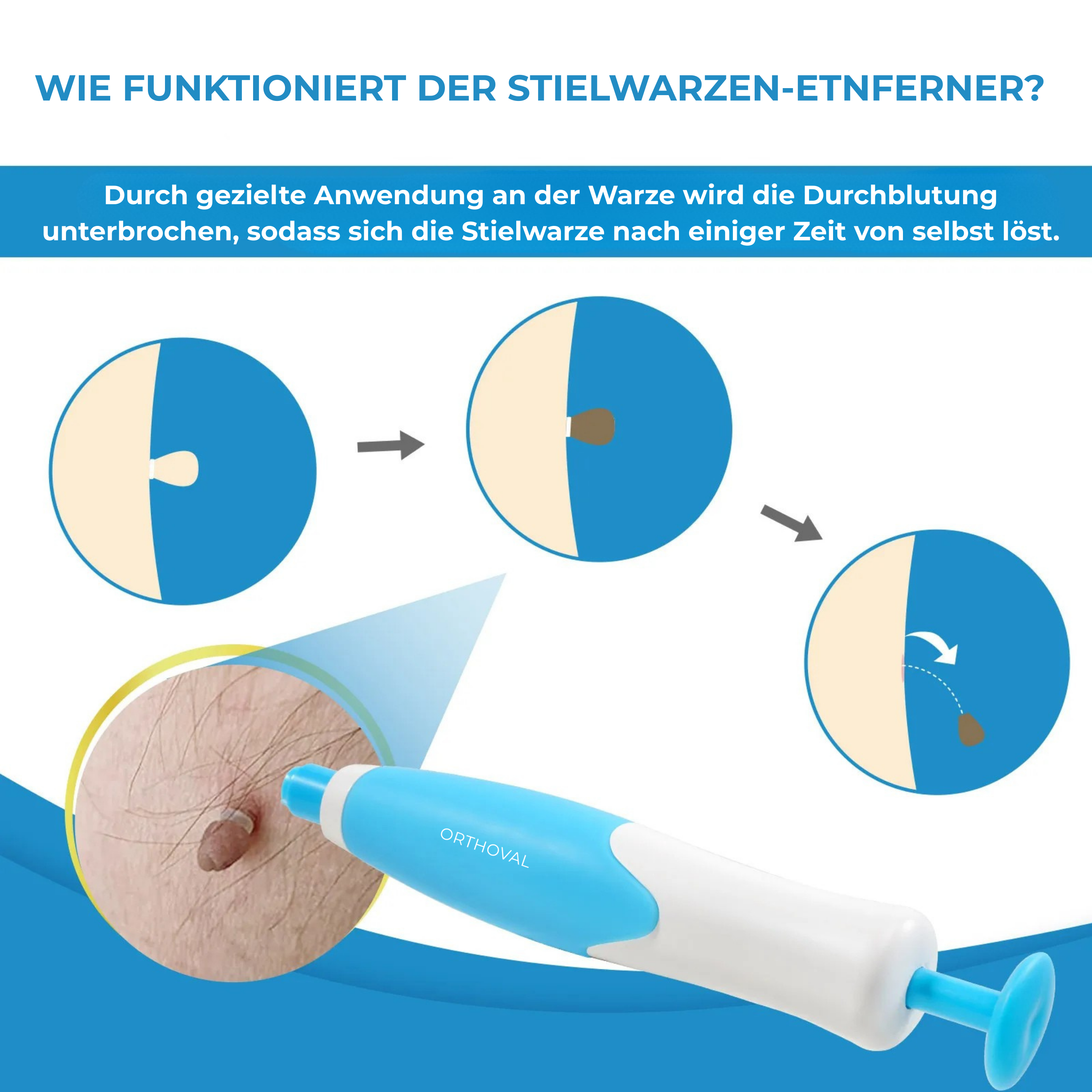 Stielwarzen-Entferner