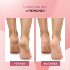 Orthoval Hornhautentferner