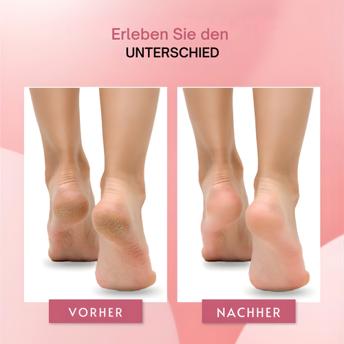 Orthoval Hornhautentferner